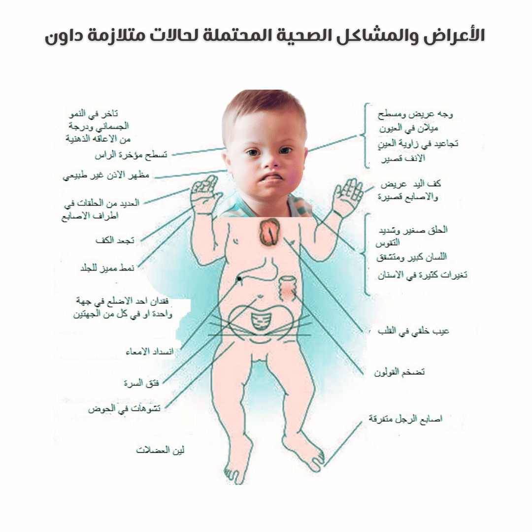 علامات متلازمة داون بالصور